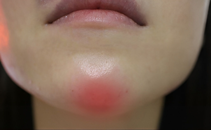 Đâu là dấu hiệu tiêm filler cằm bị hoại tử và cách xử lý