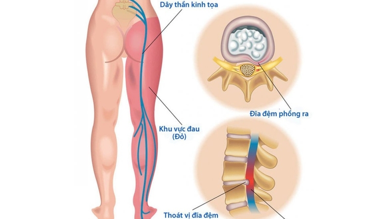 Đau lưng bên trái là dấu hiệu bệnh nguy hiểm nào? 1
