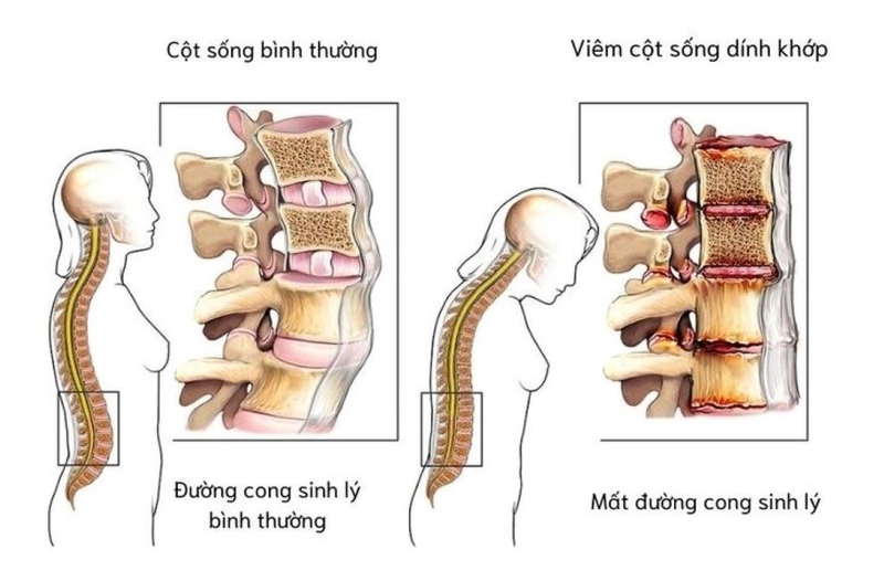 Đau lưng kiểu viêm là bệnh gì và nó có liên quan đến viêm cột sống dính khớp? 2