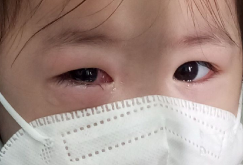 Đau mắt đỏ có được uống rượu không? 2