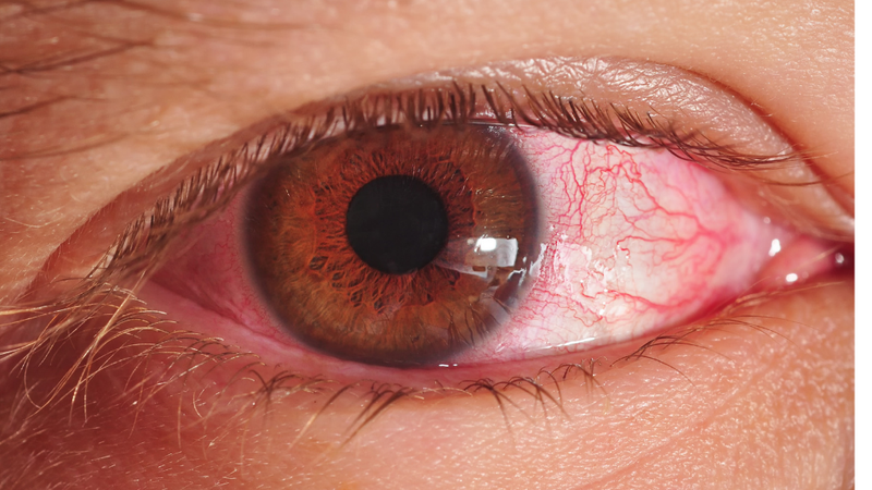 Đau mắt đỏ có được xem điện thoại không? Cần lưu ý gì khi bạn bị đau mắt đỏ? 1