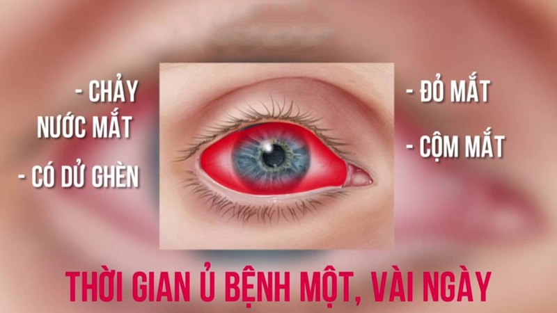 đau mắt đỏ có tự khỏi không 01