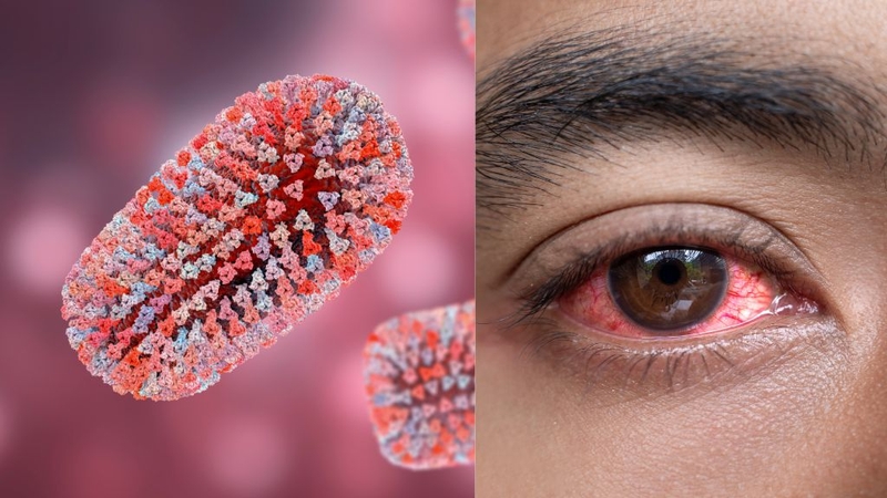 Đau mắt đỏ khi nào hết lây? Phải phòng bệnh như thế nào? 1