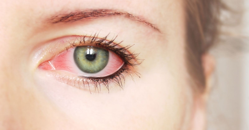 Đau mắt đỏ không khỏi là do đâu? 1