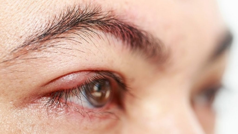 Đau mắt đỏ khi nào hết lây? Phải phòng bệnh như thế nào? 1