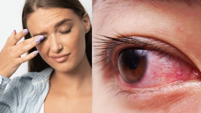 Đau mắt đỏ lâu ngày không khỏi: Nguyên nhân? 2