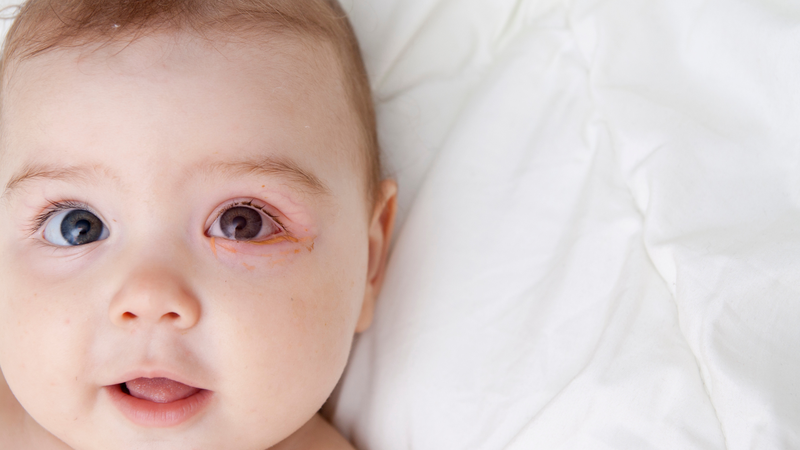 Đau mắt đỏ ở trẻ sơ sinh: Tìm hiểu triệu chứng và cách chữa bệnh 1