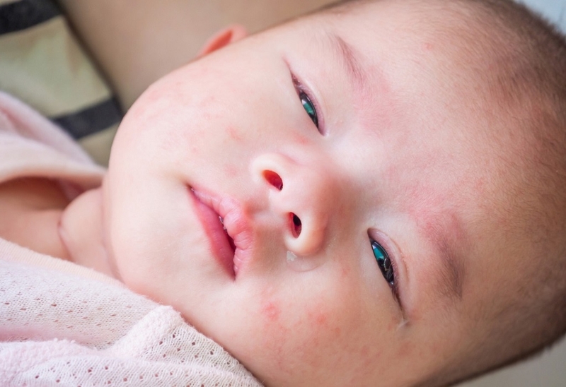 Đau mắt đỏ ở trẻ sơ sinh: Tìm hiểu triệu chứng và cách chữa bệnh 2