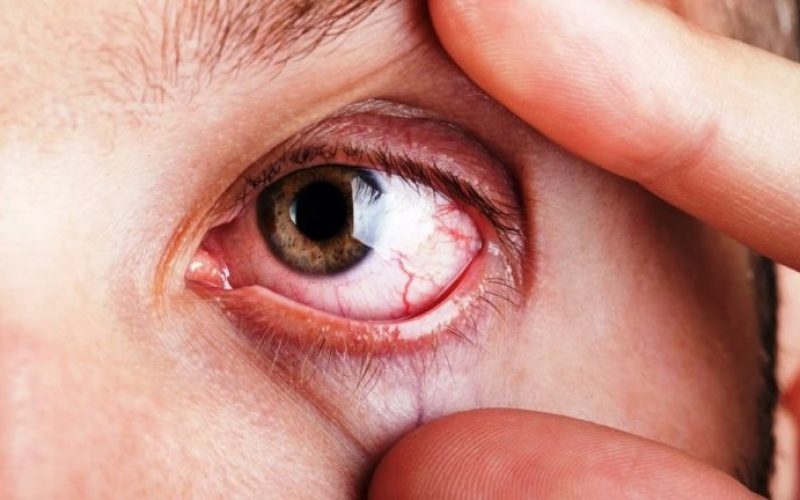 Bị đau mắt đỏ tiêm thuốc gì? Có nên hay không? 1