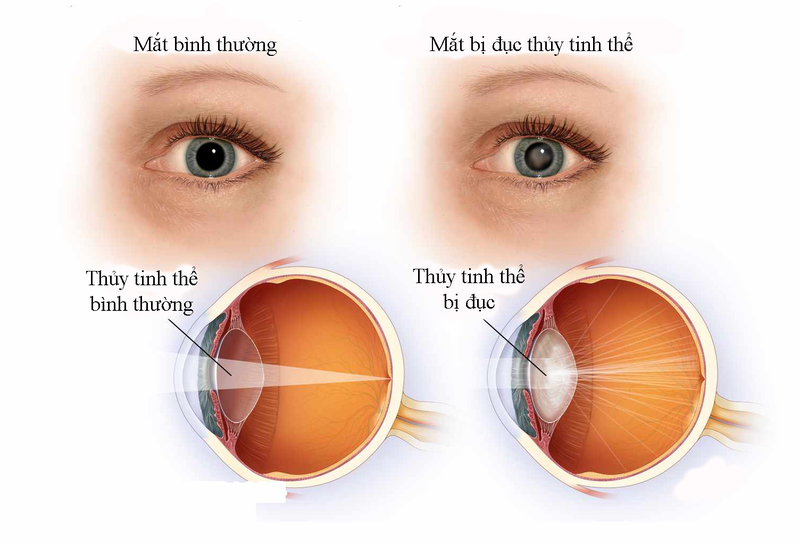 Bệnh đau mắt hột mãn tính