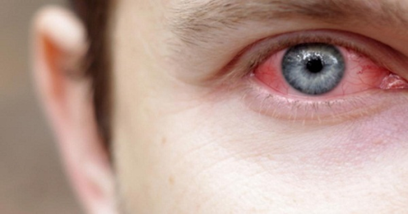 Nguyên nhân, triệu chứng và phương pháp điều trị đau mắt phải 2
