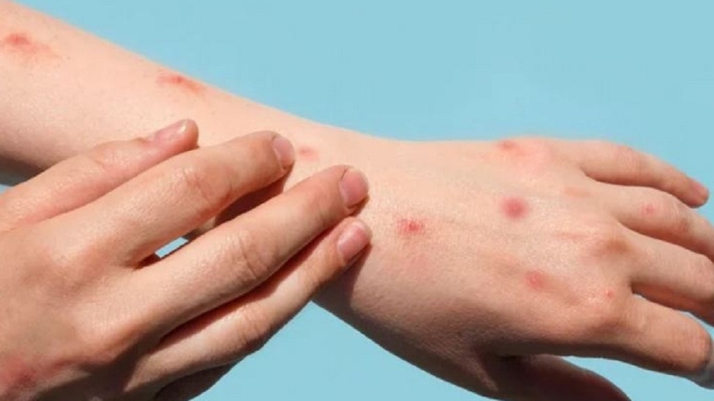 Đậu mùa khỉ có lây qua đường tình dục không? 1