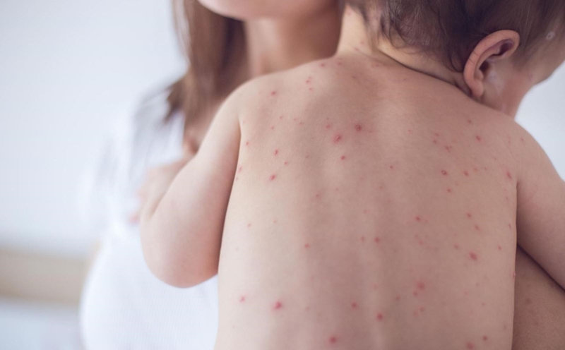 Đậu mùa khỉ: Vaccine đậu mùa khỉ1