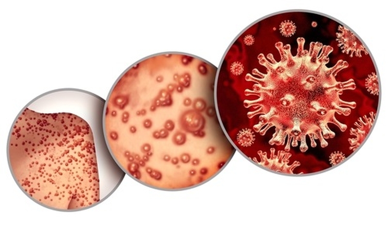 Đậu mùa khỉ: Vaccine đậu mùa khỉ2