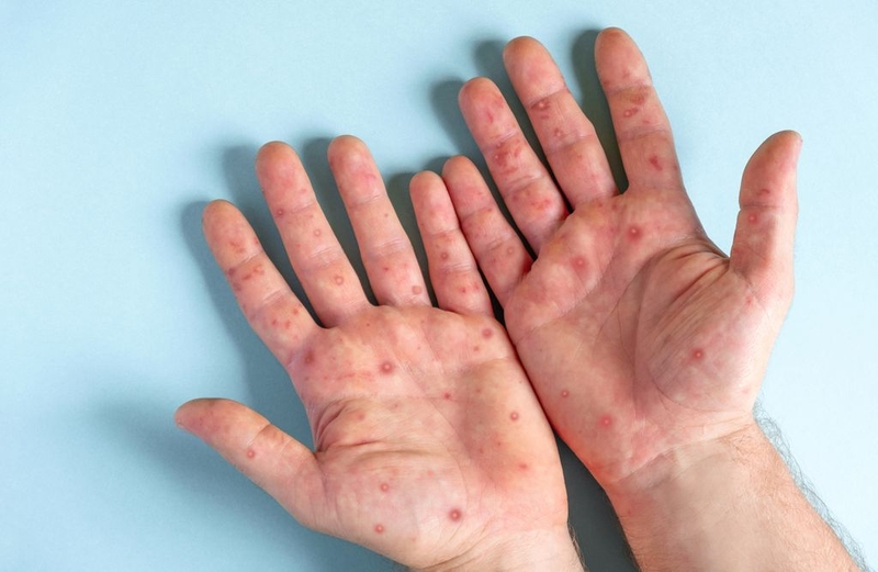 Đậu mùa lây mạnh nhất ở giai đoạn nào? Triệu chứng tương ứng với từng giai đoạn của bệnh 3