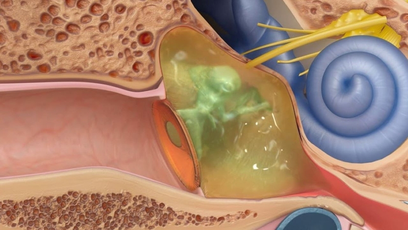 Đau nhói trong tai trái là dấu hiệu của bệnh gì? Cách khắc phục như thế nào? 1