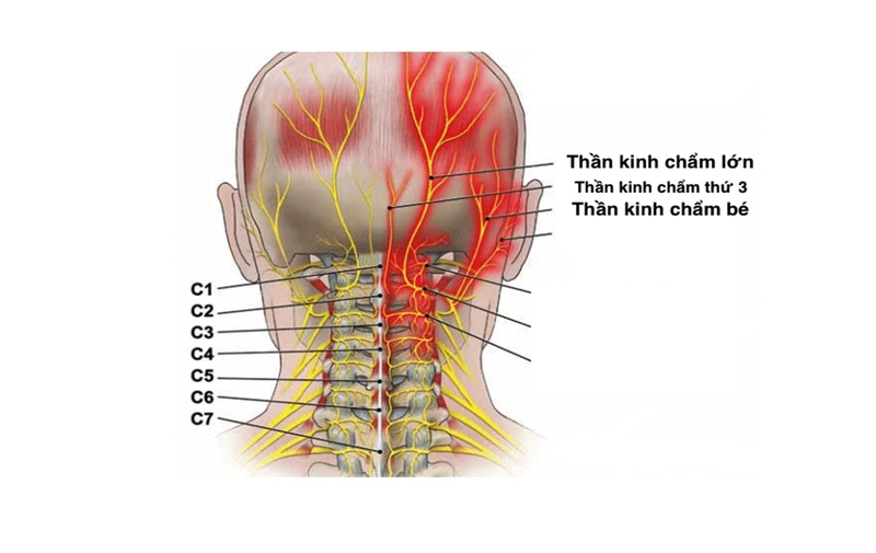 Đau sau gáy cảnh báo bệnh gì? Nguyên nhân và cách điều trị 2