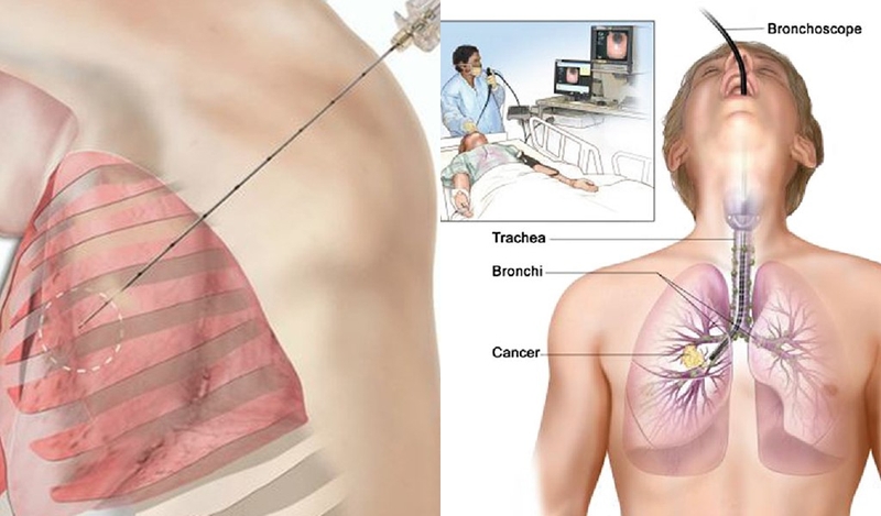 đau sau lưng vùng phổi 4