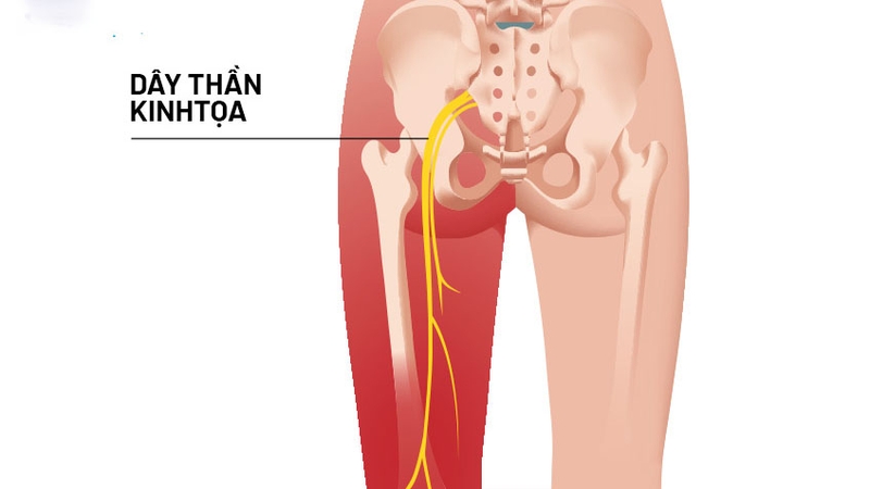Đau thần kinh ngồi là gì? Triệu chứng và cách phòng ngừa 1