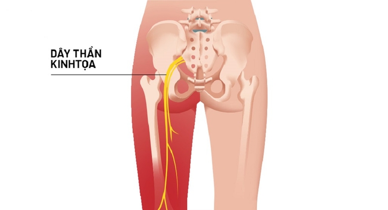 Đau thần kinh tọa có đi xe đạp được không, có ảnh hưởng gì không? 1