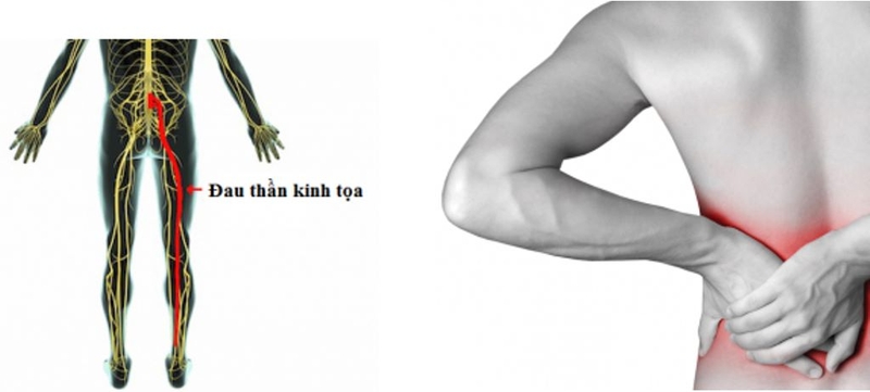 Đau thần kinh tọa có nên tập thể dục không? Các bài tập phù hợp với người đau thần kinh tọa 1