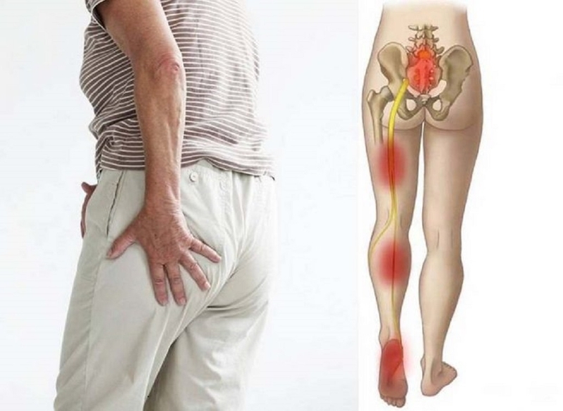 Đau thần kinh tọa và thoát vị đĩa đệm khác nhau ở những điểm nào? 2