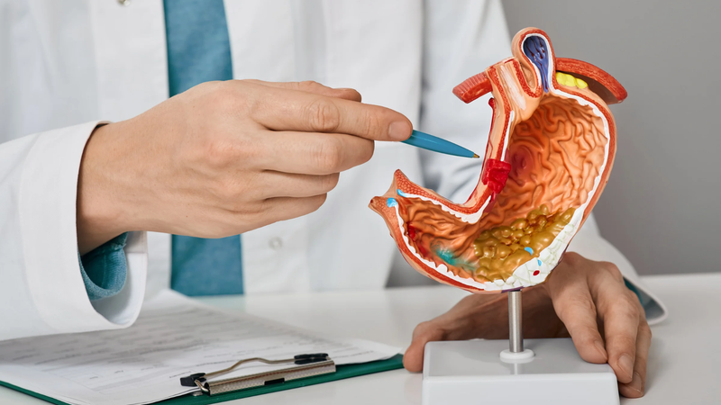 Loét dạ dày - tá tràng là một trong những nguyên nhân gây nên đau thượng vị đại tiện kèm phân đen