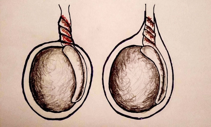 Đau tinh hoàn là gì? Nguyên nhân, chẩn đoán và điều trị đau tinh hoàn 4