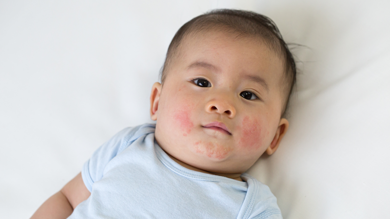 Dầu tràm dính vào mắt trẻ có sao không? Cách xử lý khi bị dầu tràm dính vào mắt 4