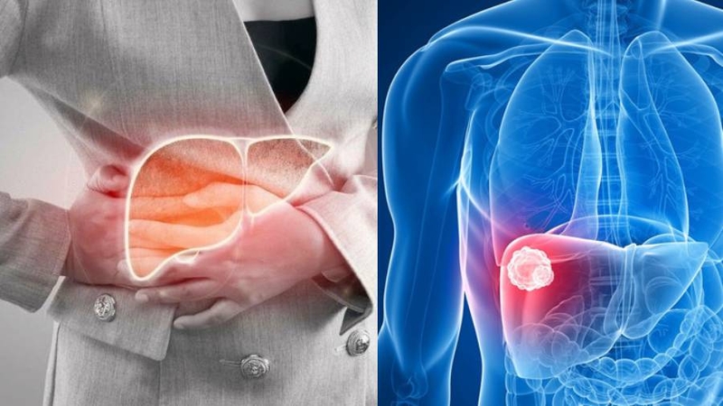 Đau tức hạ sườn phải và sự cảnh báo về các bệnh lý nguy hiểm 1