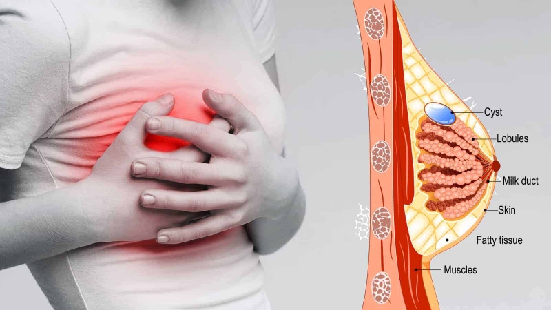 Đau vú là gì? Những nguyên nhân gây đau vú và những biện pháp điều trị hiệu quả hiện nay 1.jpg