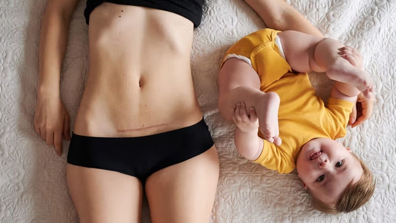 Theo dõi các triệu chứng bất thường sau sinh mổ giúp phát hiện sớm biến chứng