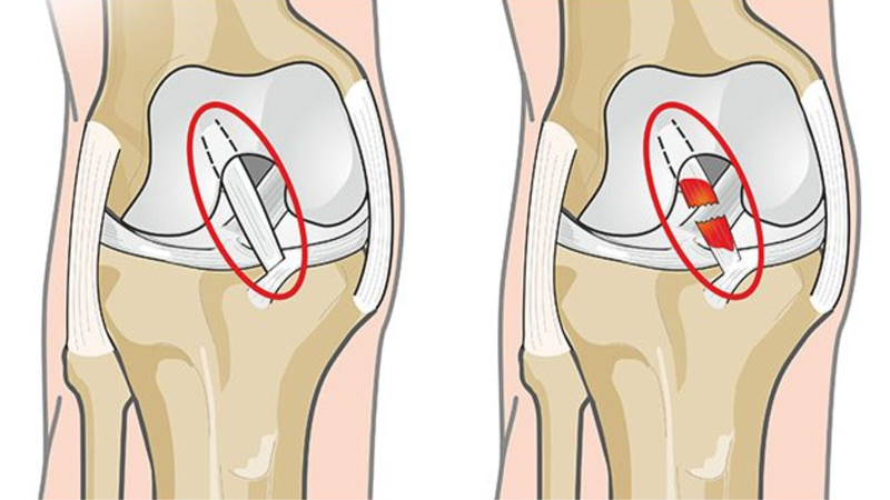 Dây chằng đầu gối cấu tạo như thế nào? Các chấn thương thường gặp 2