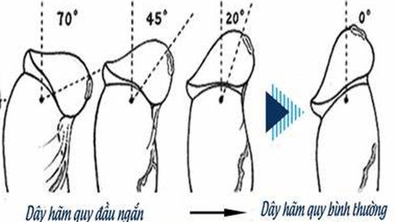 Dây hãm bao quy đầu là gì? Chức năng và các tổn thương thường gặp 1