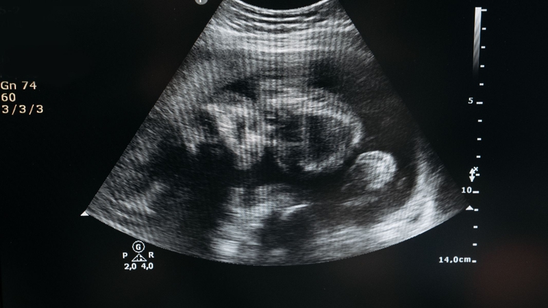 Nguyên nhân dây rốn bám mép chưa được xác định rõ, nhưng việc phát hiện sớm qua siêu âm Doppler rất quan trọng