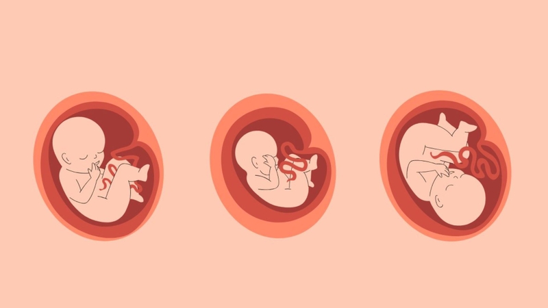 Vị trí nhau thai là yếu tố quyết định dây rốn quấn cổ 1 vòng có thể sinh thường không