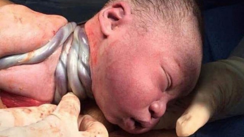 Dây rốn quấn cổ 1 vòng tuần 32 có nguy hiểm không? Cách xử lý như thế nào? 2