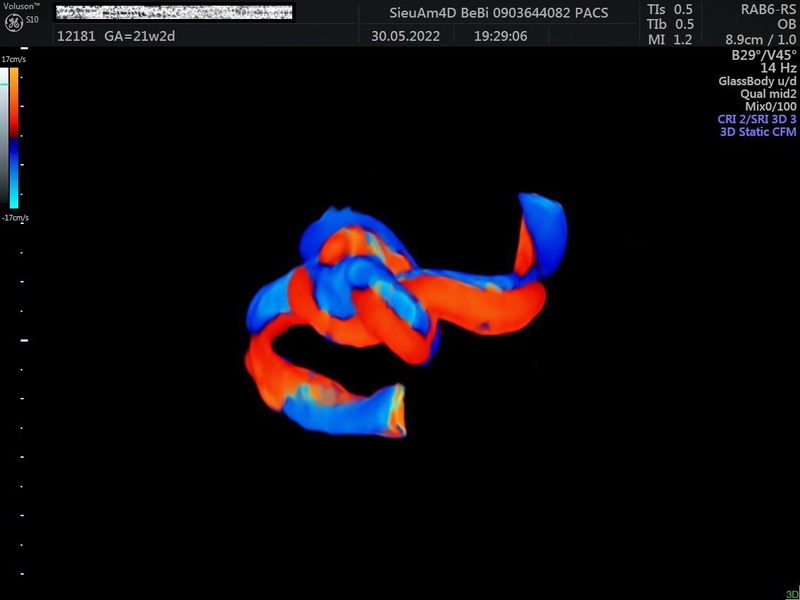 Dây rốn thắt nút Quá trình hình thành và mức độ nguy hiểm 1