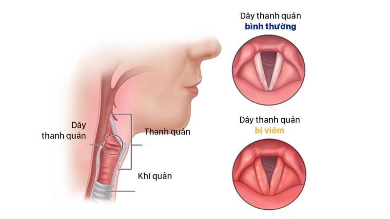 Dây thanh quản là gì? Dây thanh quản nằm ở đâu? 4