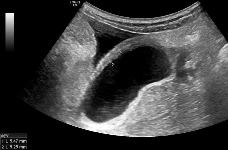 Dày thành túi mật nguyên nhân do đâu? Có nguy hiểm không?