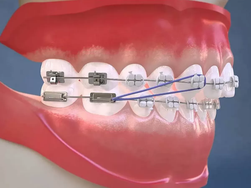 Dây thun niềng răng có tác dụng gì?-3