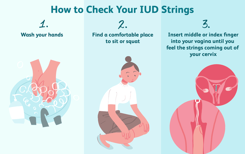 Dây vòng tránh thai thò ra ngoài có sao không? Xử lý như thế nào? 4