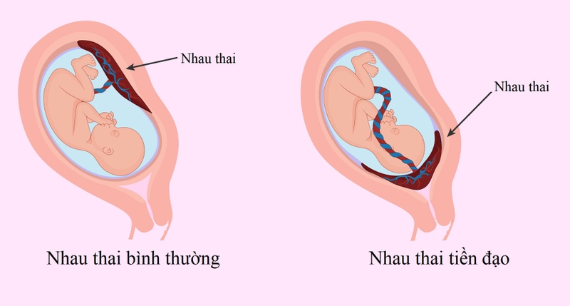 Dính buồng tử cung là gì? Nguyên nhân, triệu chứng và cách điều trị 4