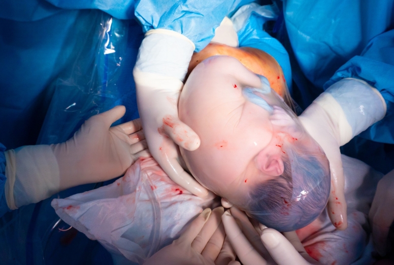 Đẻ bọc điều là gì? Nguy hiểm hay may mắn?