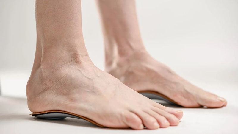 Trong nhiều trường hợp, đế chỉnh hình giúp giảm cảm giác khó chịu của người có bàn chân bẹt