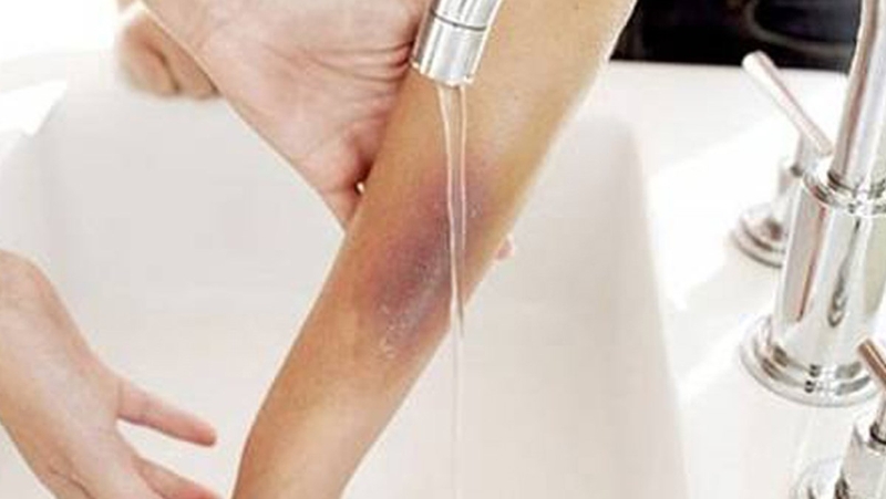 Việc rửa sạch vết thương cần thực hiện dưới dạng vòi nước chảy liên tục chứ không ngâm trực tiếp trong nước