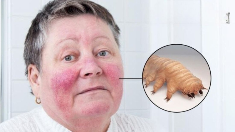 Xét nghiệm Demodex soi tươi có ý nghĩa gì? Thực hiện thế nào 2