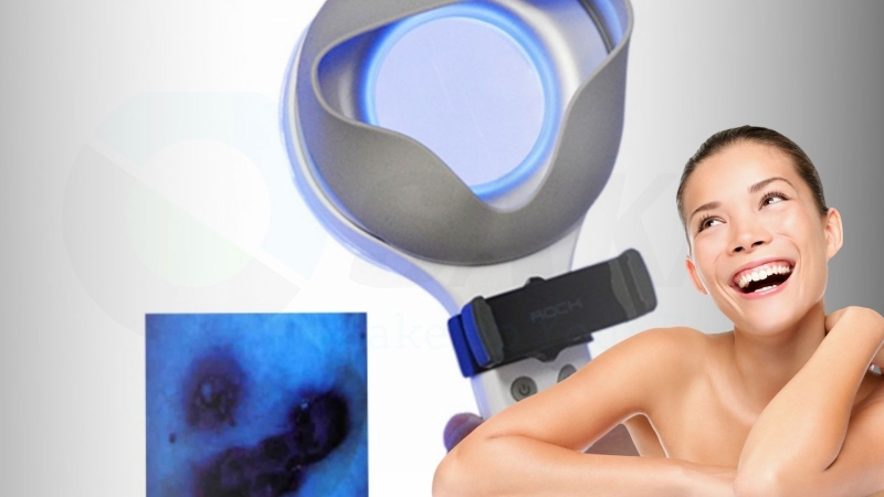 Nốt ruồi son là gì? Làm thế nào để xóa nút ruồi son? 2