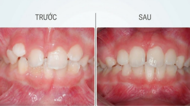 Hiệu quả thay đổi rõ sau vài tháng đeo hàm Trainer tuân thủ chỉ định