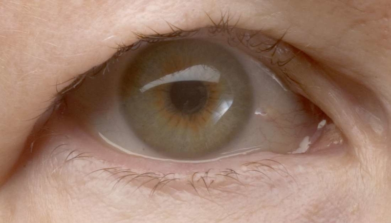 Đeo kính bị sụp mí: Nguyên nhân và giải pháp hiệu quả nhất 2